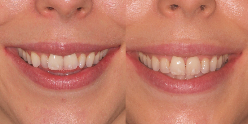 Invisalign